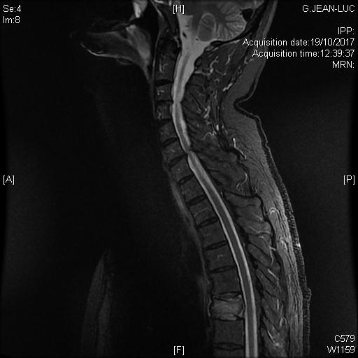 Plasmocytome solitaire du rachis dorsal découvert dans le cadre du bilan d'une fracture vertébrale dorsale spontanée