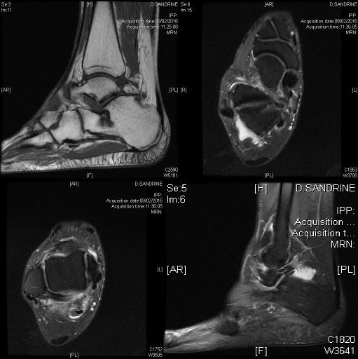 Syndrome du carrefour postérieur de la cheville sur os trigone accessoire à l'IRM