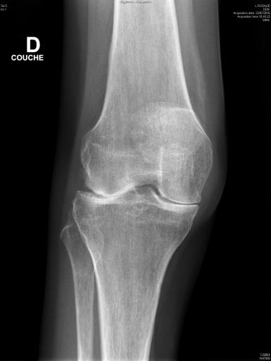 arthrite destructrice évoluée du genou dans le cadre d'une polyarthrite rhumatoïde