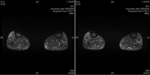 Tableau clinique de polymyosite avec atteinte clinique et IRM des deux jambes