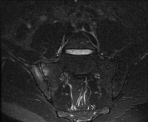 Sacro-iliite droite dans le cadre d'une spondyloarthrite axiale