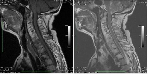 Atteinte rachidienne cervicale évoluée dans le cadre d'une spondyloarthrite axiale radiographique
