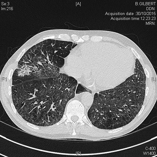 fibrose pulmonaire dans le cadre d'une sclérodermie systémique