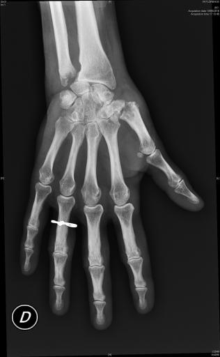 polyarthrite rhumatoïde érosive avec signe de Freiberg radiographique au poignet